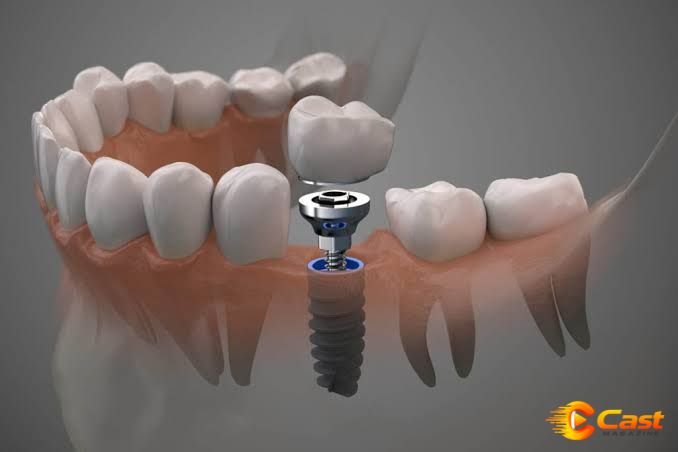 Dental Implants Last