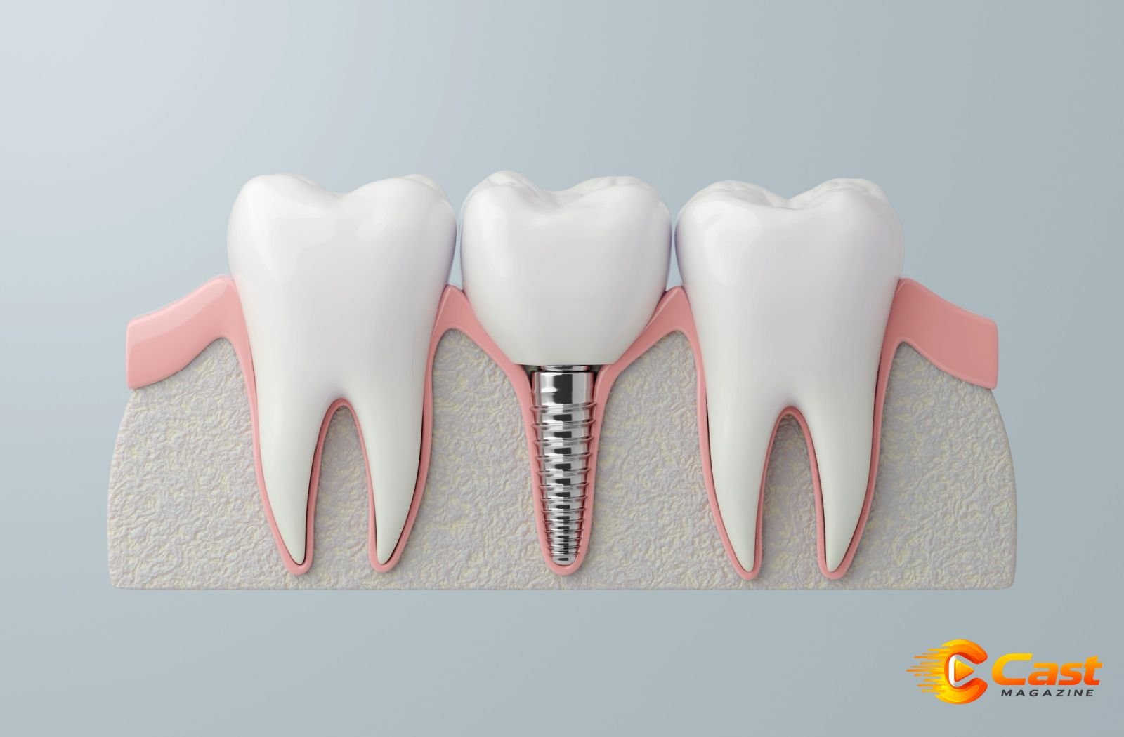 Dental implants vs. dental bridges