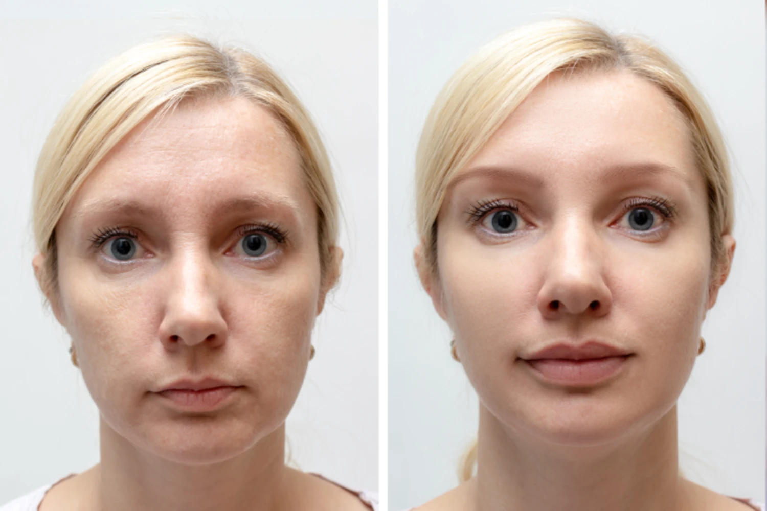 wrinkle relaxers